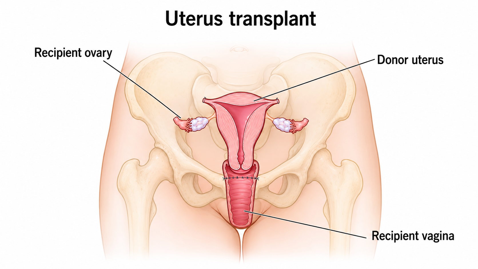 Uterus transplant anatomy and blood vessel connection